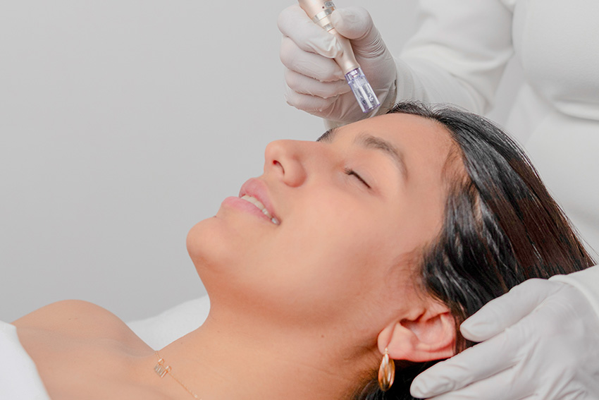 Servicio de Microneedling (Dermapen)